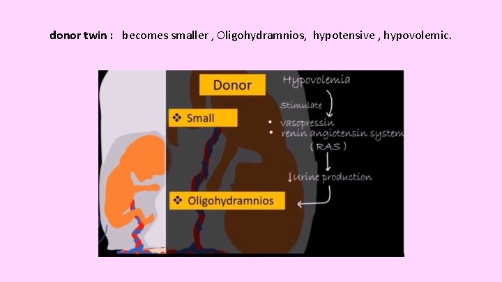 donor twin : becomes smaller , Oligohydramnios, hypotensive , hypovolemic. 