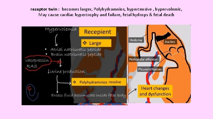 receptor twin : becomes larger, Polyhydramnios, hypertensive , hypervolemic, May cause cardiac hypertrophy and