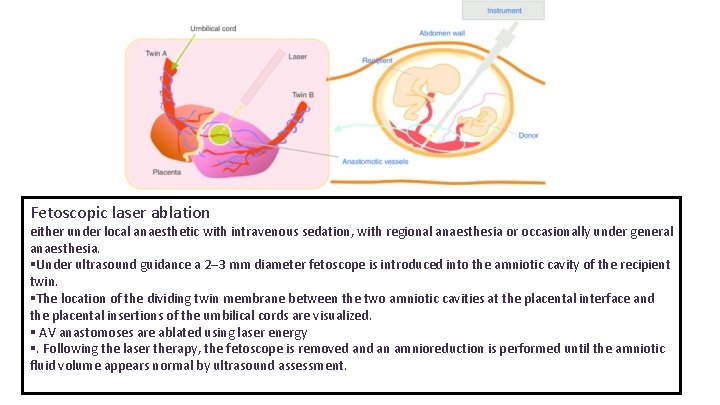 Fetoscopic laser ablation either under local anaesthetic with intravenous sedation, with regional anaesthesia or