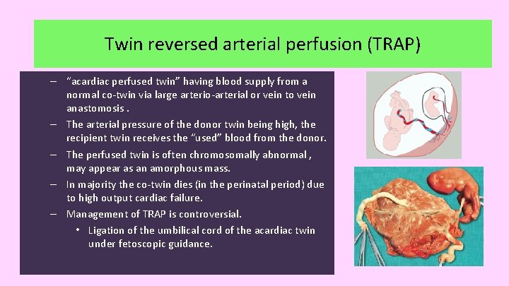 Twin reversed arterial perfusion (TRAP) – “acardiac perfused twin” having blood supply from a