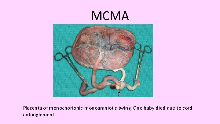 MCMA Placenta of monochorionic-monoamniotic twins, One baby died due to cord entanglement 
