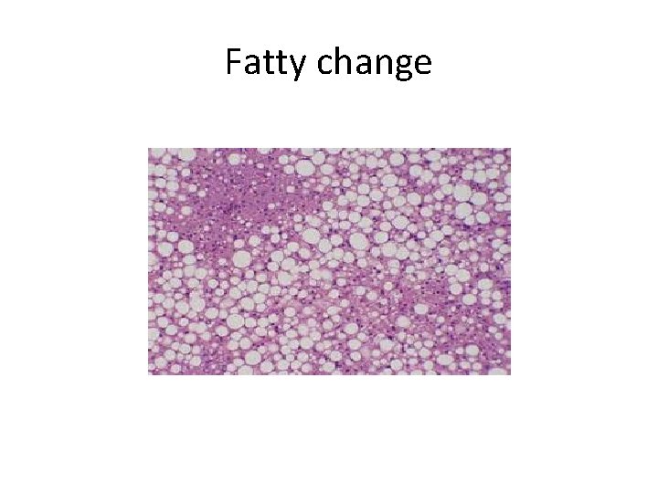 Fatty change 