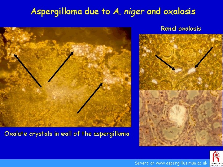 Aspergilloma due to A. niger and oxalosis Renal oxalosis Oxalate crystals in wall of