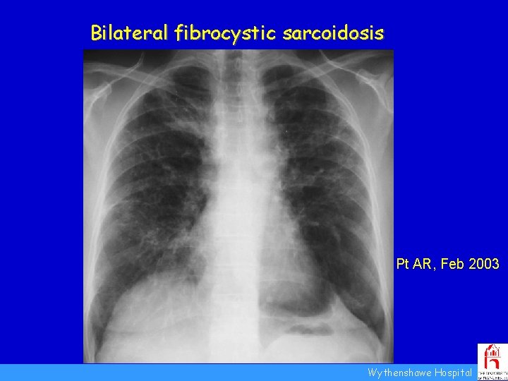 Bilateral fibrocystic sarcoidosis Pt AR, Feb 2003 Wythenshawe Hospital 