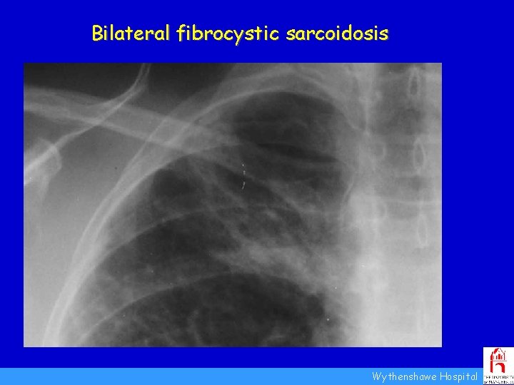Bilateral fibrocystic sarcoidosis Pre-existing cavities Pt AR, Feb 2004 Wythenshawe Hospital 