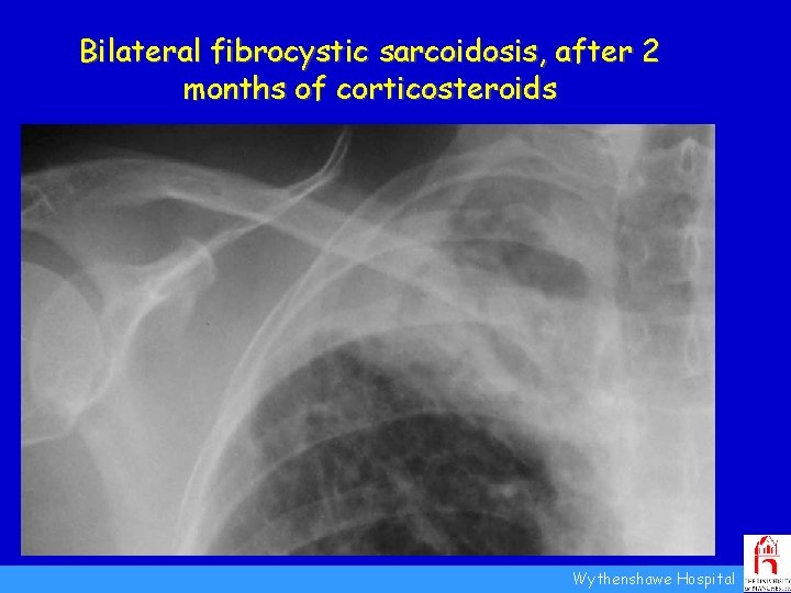 Bilateral fibrocystic sarcoidosis, after 2 months of corticosteroids New cavity formation Pleural thickening Small