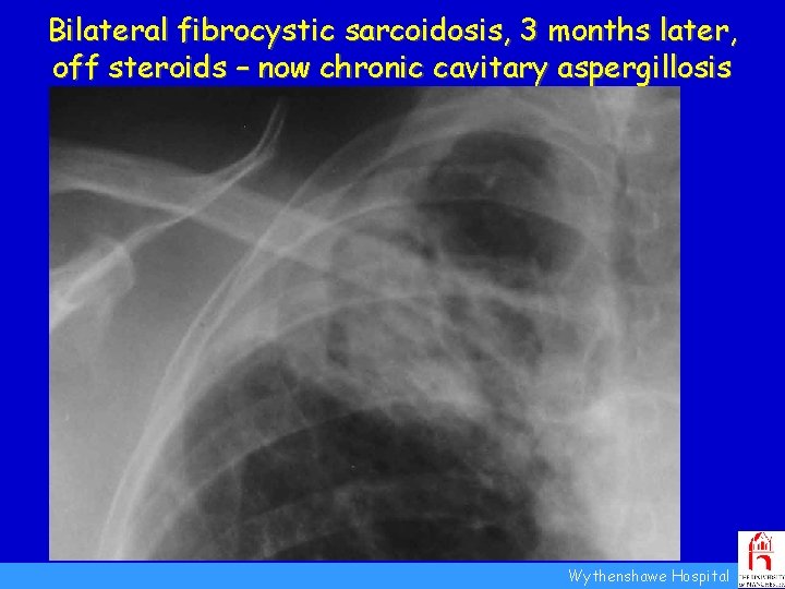 Bilateral fibrocystic sarcoidosis, 3 months later, off steroids – now chronic cavitary aspergillosis New