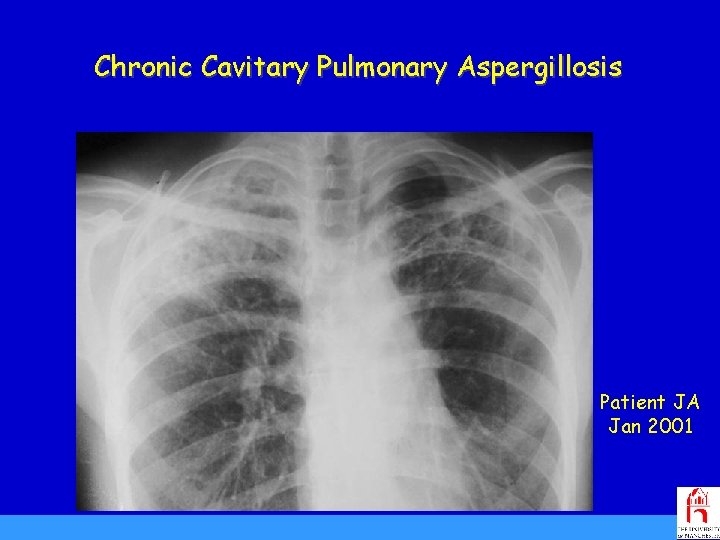Chronic Cavitary Pulmonary Aspergillosis Patient JA Jan 2001 