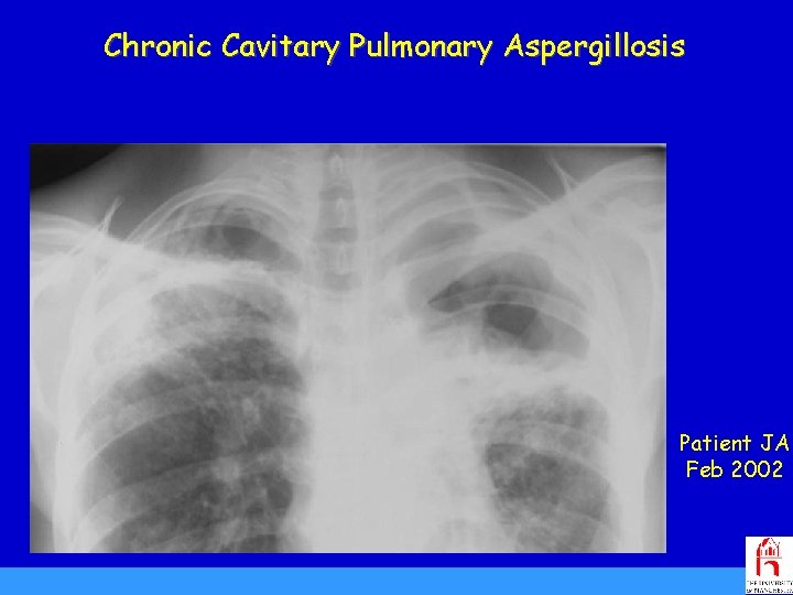 Chronic Cavitary Pulmonary Aspergillosis Patient JA Feb 2002 