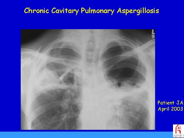 Chronic Cavitary Pulmonary Aspergillosis Patient JA April 2003 