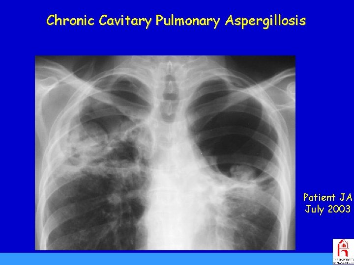 Chronic Cavitary Pulmonary Aspergillosis Patient JA July 2003 