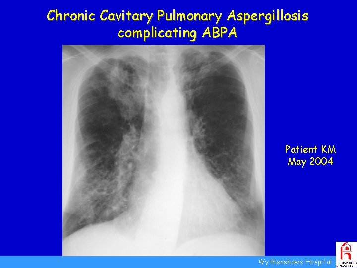 Chronic Cavitary Pulmonary Aspergillosis complicating ABPA Patient KM May 2004 Wythenshawe Hospital 