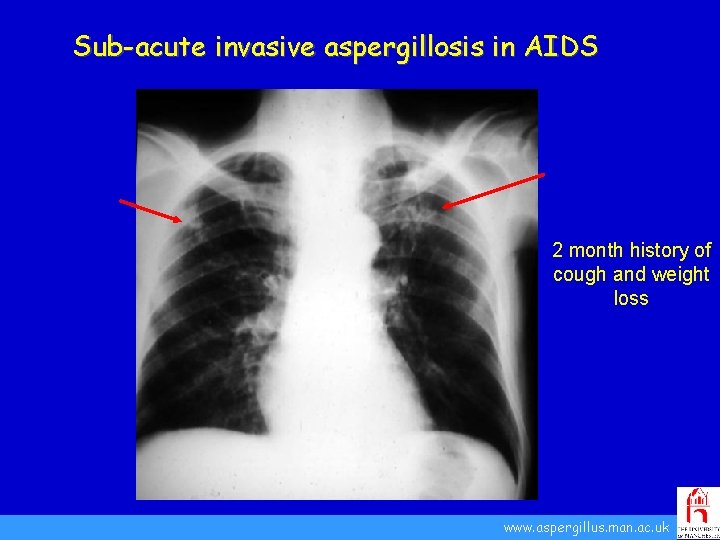 Sub-acute invasive aspergillosis in AIDS 2 month history of cough and weight loss www.