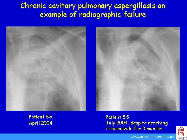Chronic cavitary pulmonary aspergillosis an example of radiographic failure Patient SS April 2004 Patient