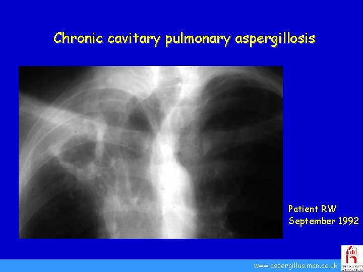 Chronic cavitary pulmonary aspergillosis Patient RW September 1992 www. aspergillus. man. ac. uk 
