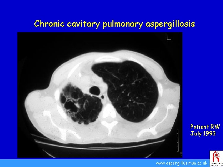 Chronic cavitary pulmonary aspergillosis Patient RW July 1993 www. aspergillus. man. ac. uk 