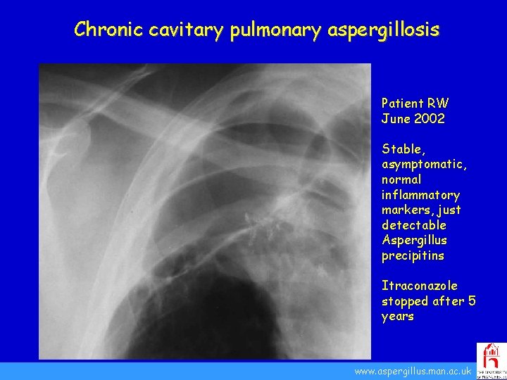 Chronic cavitary pulmonary aspergillosis Patient RW June 2002 Stable, asymptomatic, normal inflammatory markers, just