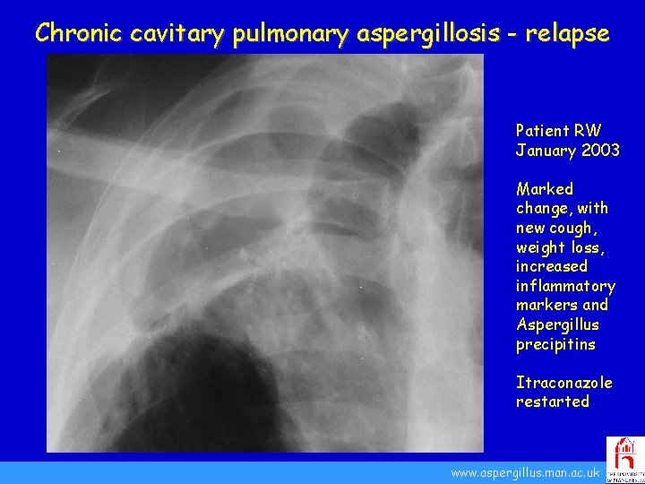 Chronic cavitary pulmonary aspergillosis - relapse Patient RW January 2003 Marked change, with new