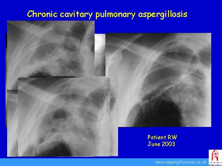 Chronic cavitary pulmonary aspergillosis Patient RW September 1992 Patient RW June 2003 www. aspergillus.