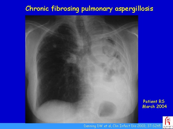 Chronic fibrosing pulmonary aspergillosis Patient RS March 2004 Denning DW et al, Clin Infect