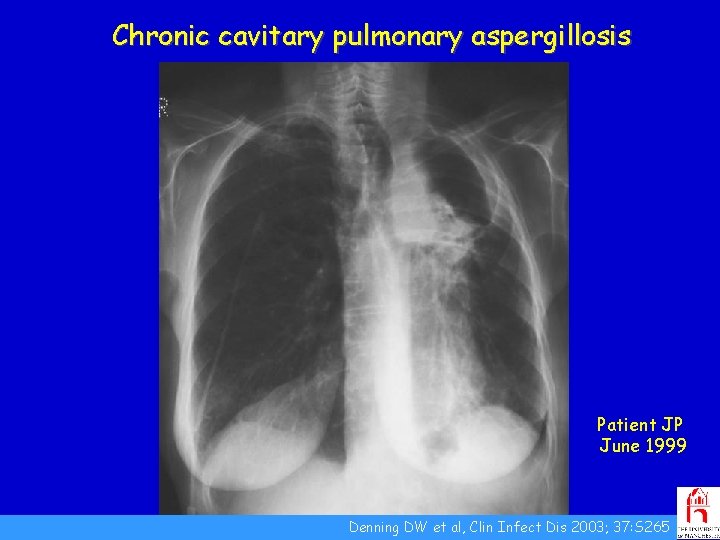 Chronic cavitary pulmonary aspergillosis Patient JP June 1999 Denning DW et al, Clin Infect