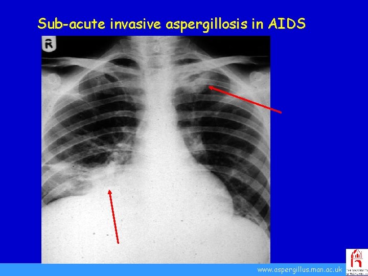 Sub-acute invasive aspergillosis in AIDS www. aspergillus. man. ac. uk 