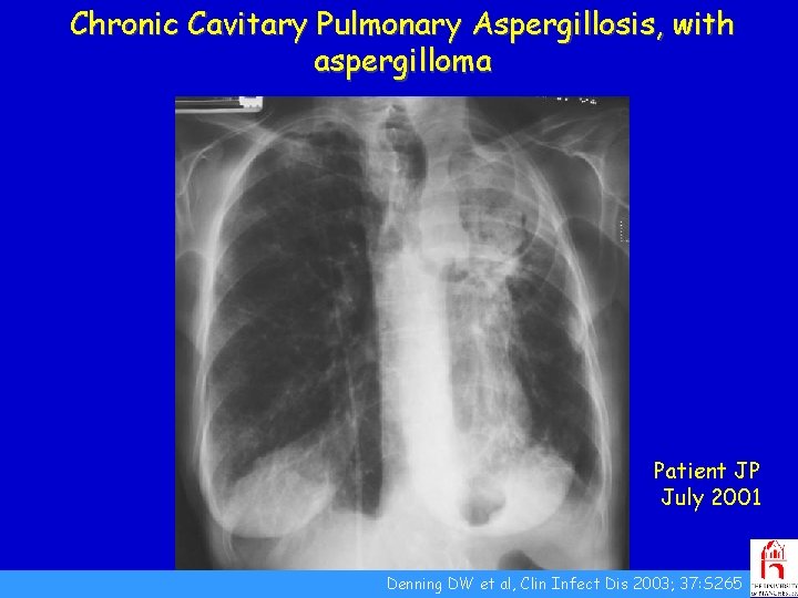 Chronic Cavitary Pulmonary Aspergillosis, with aspergilloma Patient JP July 2001 Denning DW et al,