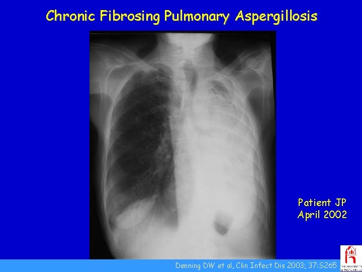 Chronic Fibrosing Pulmonary Aspergillosis Patient JP April 2002 Denning DW et al, Clin Infect