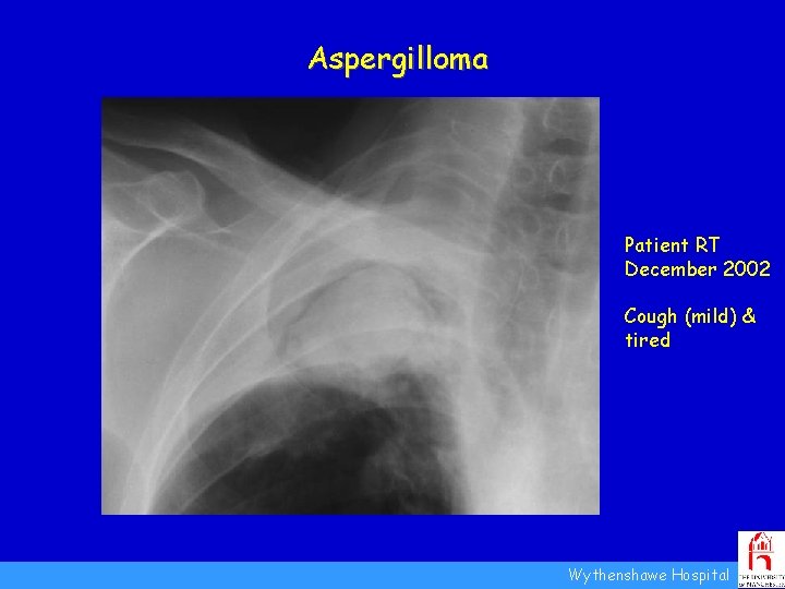 Aspergilloma Patient RT December 2002 Cough (mild) & tired Wythenshawe Hospital 