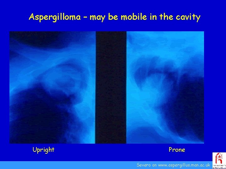 Aspergilloma – may be mobile in the cavity Upright Prone Severo on www. aspergillus.