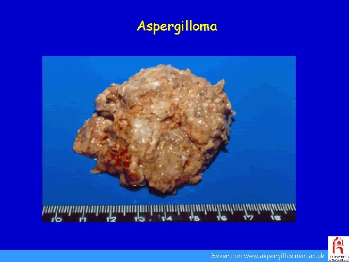 Aspergilloma Severo on www. aspergillus. man. ac. uk 