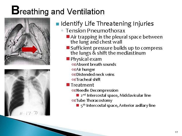 Breathing and Ventilation n Identify Life Threatening Injuries ◦ Tension Pneumothorax n Air trapping