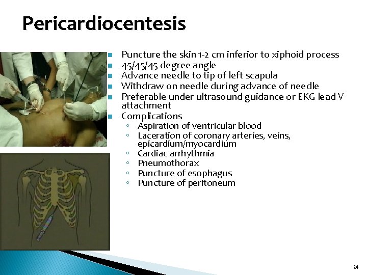 Pericardiocentesis n n n Puncture the skin 1 -2 cm inferior to xiphoid process