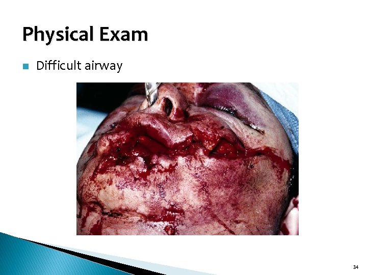 Physical Exam n Difficult airway 34 