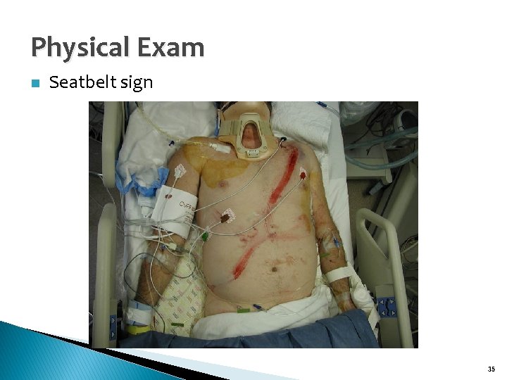Physical Exam n Seatbelt sign 35 