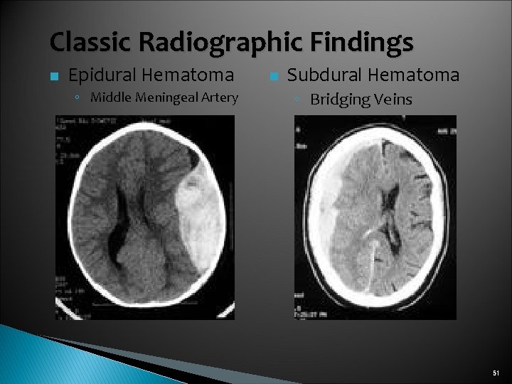 Classic Radiographic Findings n Epidural Hematoma ◦ Middle Meningeal Artery n Subdural Hematoma ◦