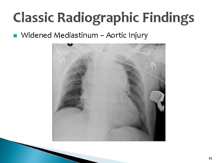 Classic Radiographic Findings n Widened Mediastinum – Aortic Injury 53 