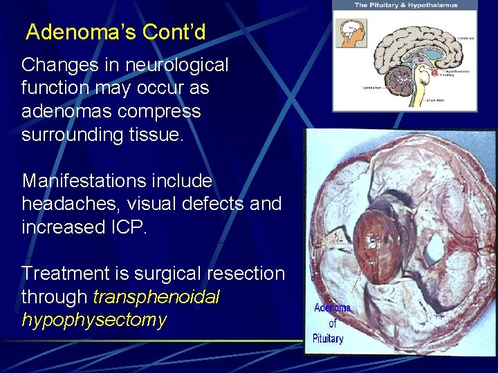 Adenoma’s Cont’d Changes in neurological function may occur as adenomas compress surrounding tissue. Manifestations