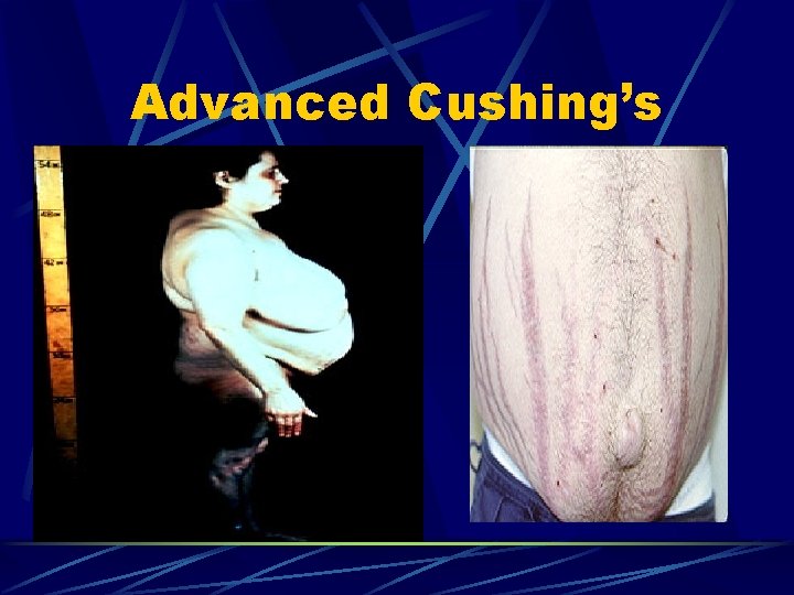 Advanced Cushing’s 