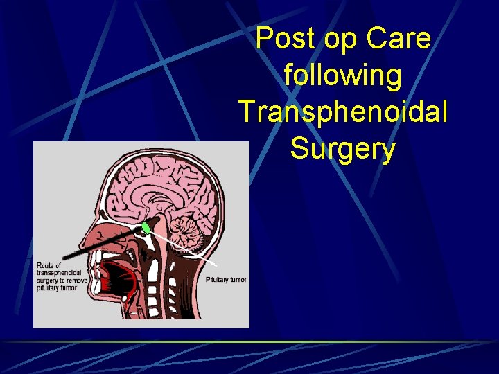 Post op Care following Transphenoidal Surgery 