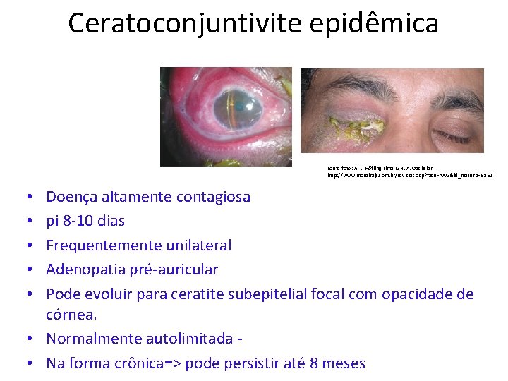 Ceratoconjuntivite epidêmica Fonte foto: A. L. Höfling-Lima & R. A. Oechsler http: //www. moreirajr.