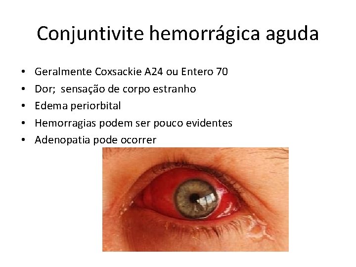 Conjuntivite hemorrágica aguda • • • Geralmente Coxsackie A 24 ou Entero 70 Dor;