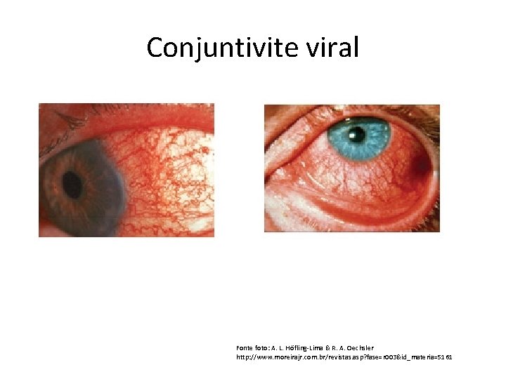 Conjuntivite viral Fonte foto: A. L. Höfling-Lima & R. A. Oechsler http: //www. moreirajr.