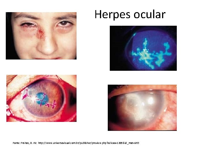 Herpes ocular Fonte: Freitas, D. IN: http: //www. universovisual. com. br/publisher/preview. php? edicao=1205&id_mat=963 