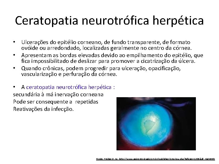 Ceratopatia neurotrófica herpética • Ulcerações do epitélio corneano, de fundo transparente, de formato ovóide
