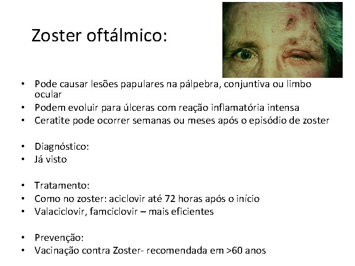 Zoster oftálmico: • Pode causar lesões papulares na pálpebra, conjuntiva ou limbo ocular •