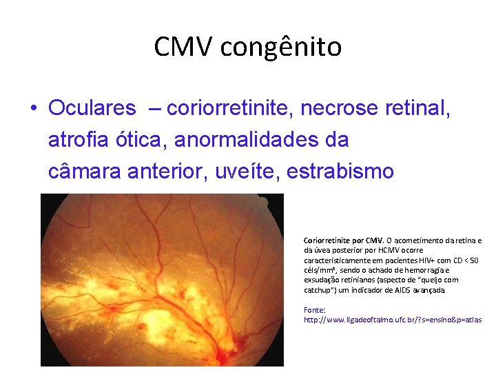 CMV congênito • Oculares – coriorretinite, necrose retinal, atrofia ótica, anormalidades da câmara anterior,