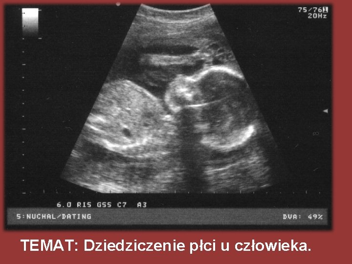 TEMAT: Dziedziczenie płci u człowieka. 