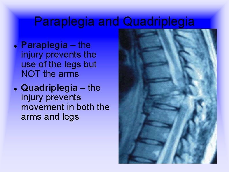 Paraplegia and Quadriplegia Paraplegia – the injury prevents the use of the legs but