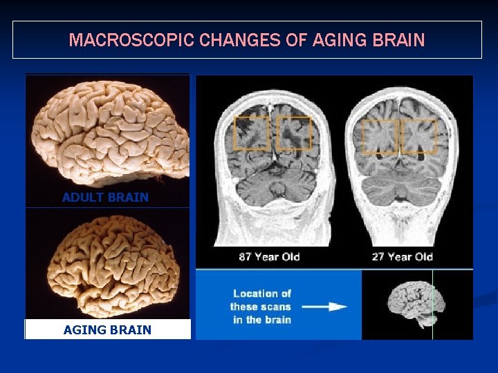 MACROSCOPIC CHANGES OF AGING BRAIN ADULT BRAIN AGING BRAIN 